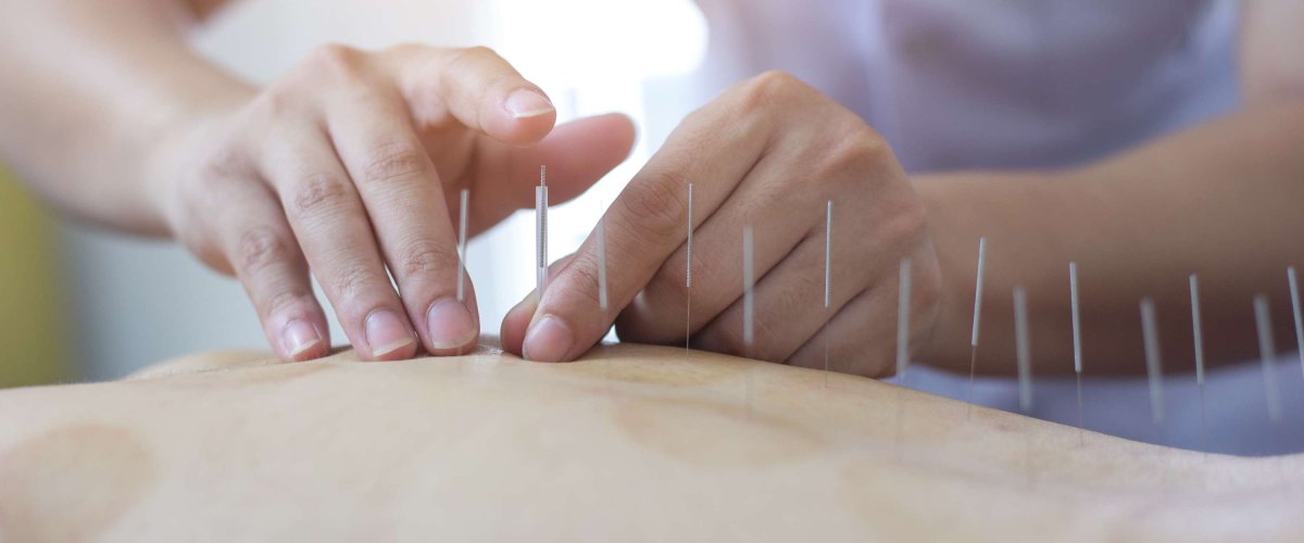 Akupunktura a aurikuloterapie